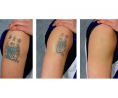 Tattoos removal cream +2567796358968